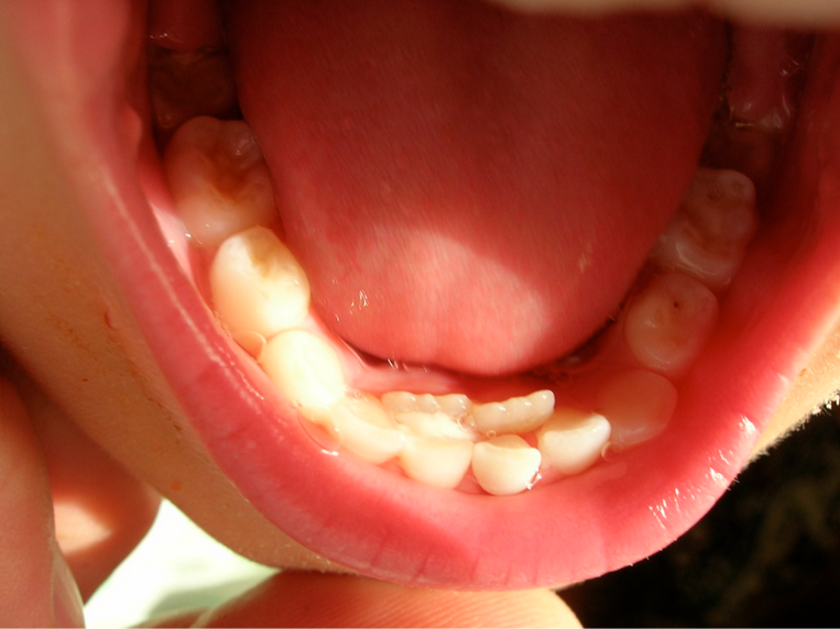 ظهور الأسنان الدائمة خلف الأسنان اللبنية